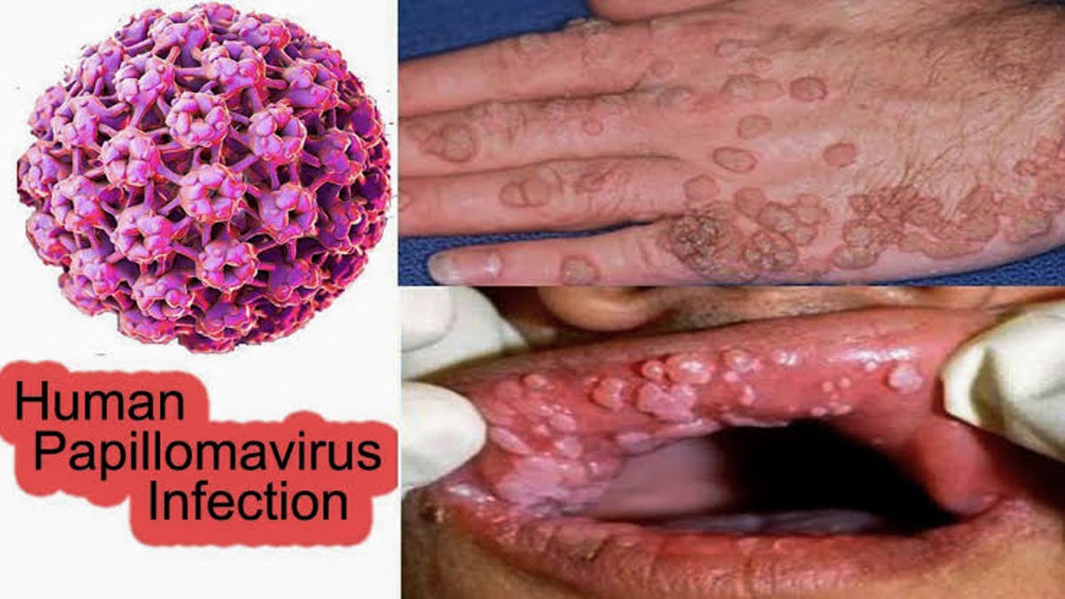 papilloma virus e lesioni