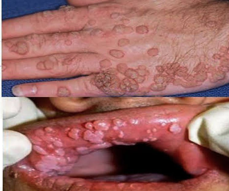 papilloma virus con lesioni