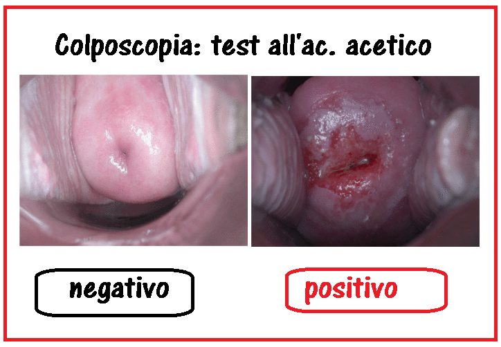 Biopsia per papilloma virus. biopsia colului uterin Papilloma virus biopsia positiva