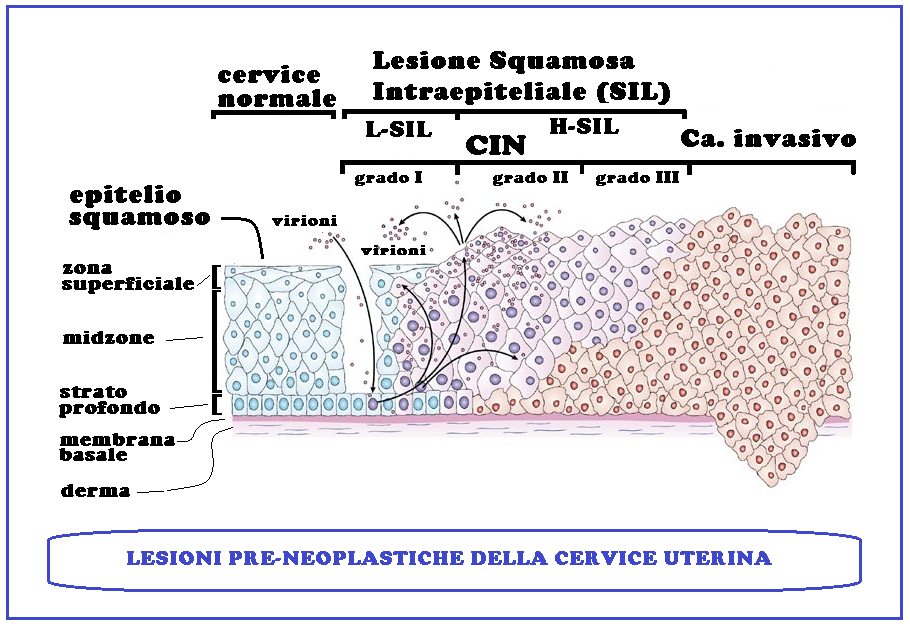 Papilloma virus lesioni precancerose. Category: DEFAULT - Papilloma virus lesioni