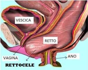 Hits: 11 Il retto è la porzione terminale dell’intestino. Lungo 13-15 cm circa, il retto collega il tratto intestinale colon-sigma con l’ano, ed è circondato da diversi muscoli e legamenti del pavimento pelvico. Tali strutture […]